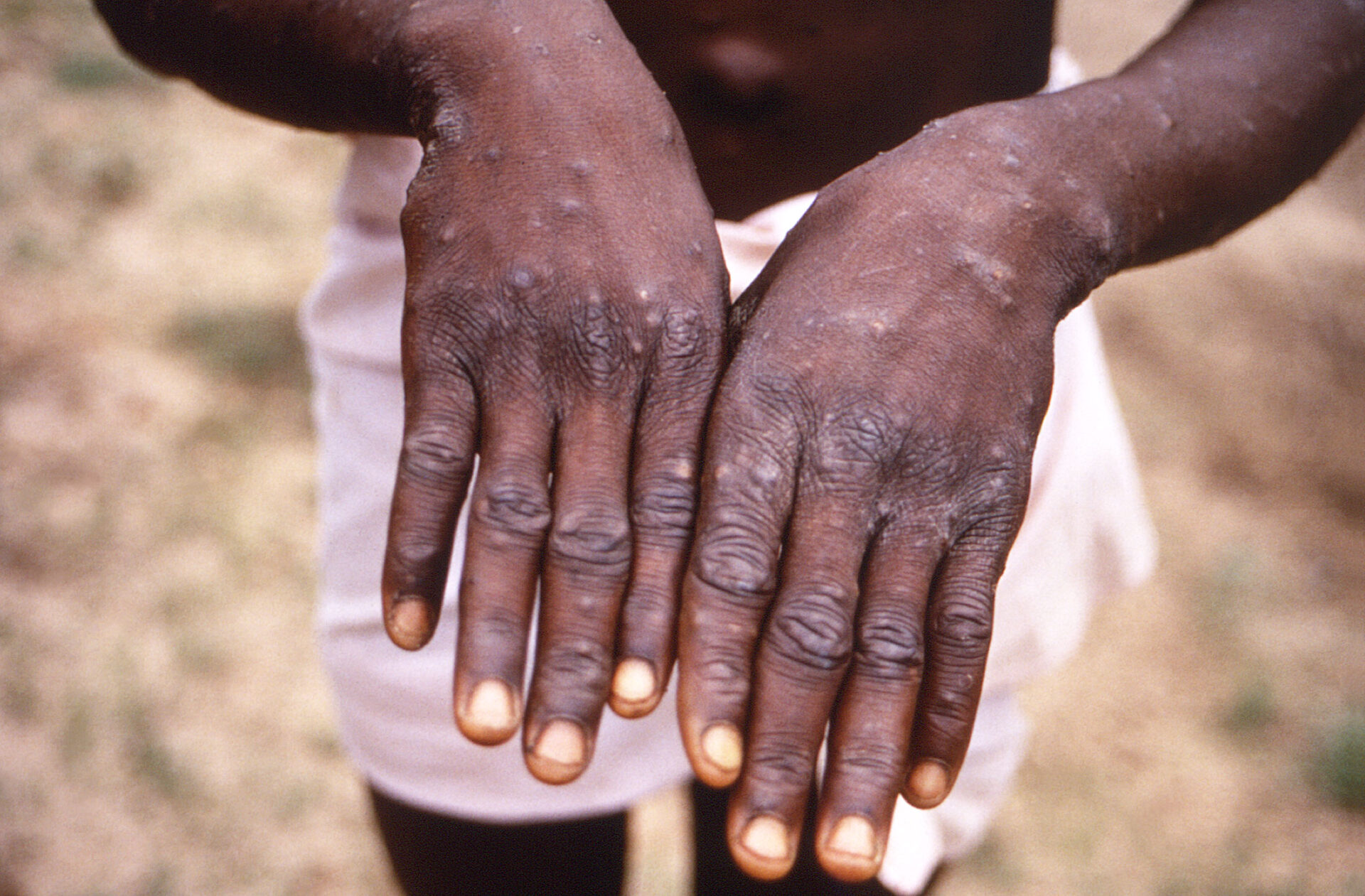 OMS mantiene emergencia internacional por mpox ante aumento de casos en África