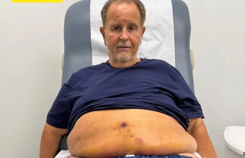 Raúl de Molina, hospitalizado de emergencia tras cirugía estética Raúl de Molina, hospitalizado de emergencia tras cirugía estética